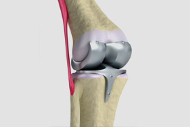 cirugia protesis de rodilla